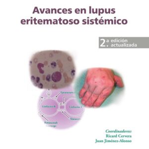 Avances en lupus eritematoso sistémico