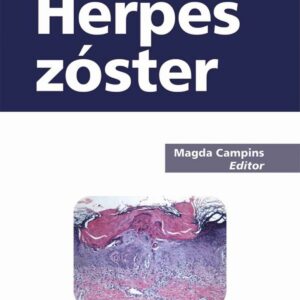 Herspes Zoster